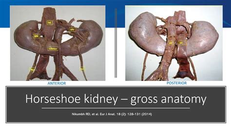 what is a horseshoe kidney